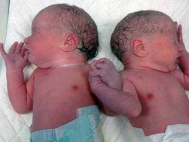 Η πιο συγκινητική φωτογραφία: Δυο αδερφάκια γεννήθηκαν χέρι-χέρι!