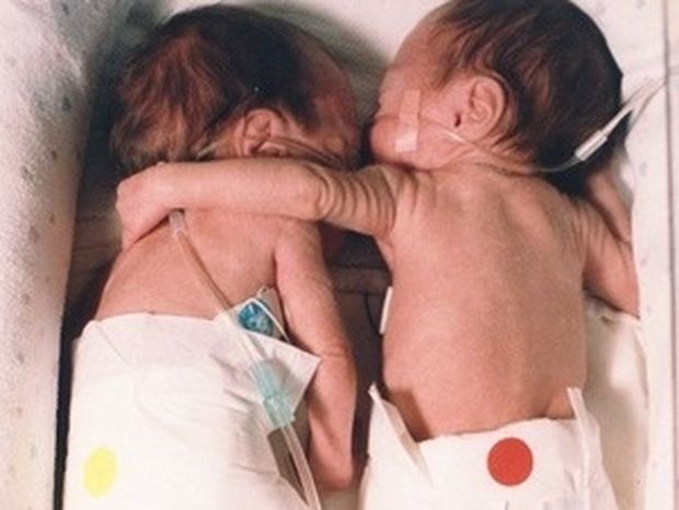 ΔΕΙΤΕ: Τα νεογέννητα που αγκαλιάστηκαν για να επιβιώσουν... μεγάλωσαν!