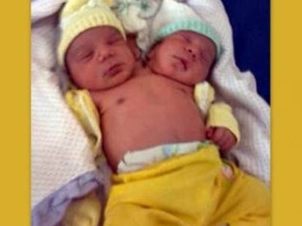 Γεννήθηκε μωρό στη Βραζιλία με δύο κεφάλια