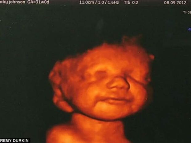 ΣΥΓΚΙΝΗΤΙΚΟ: Είδε το αγέννητο μωρό της να χαμογελά και δεν έκανε έκτρωση