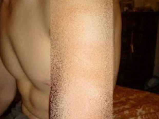 Xτύπημα από κεραυνό - Δείτε τι κάνει στο ανθρώπινο δέρμα (pics)