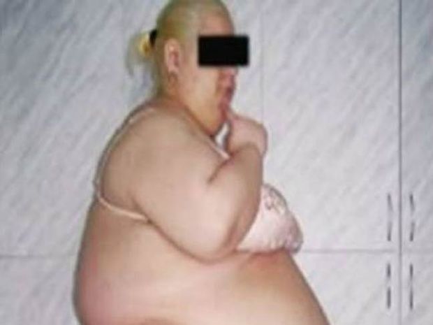 Σοκαριστικό: Αφαίρεσαν λίπος 57 κιλών από την κοιλιά μιας Ρωσίδας