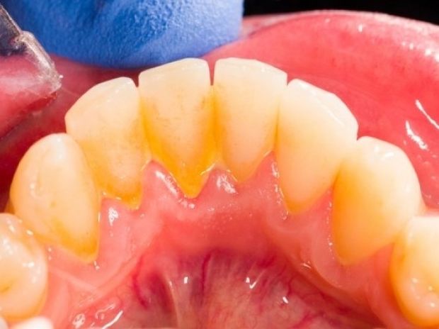 Πλάκα στα δόντια: Πώς θα την απομακρύνετε