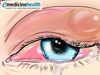 «Κριθαράκι» στο μάτι: Αίτια και αντιμετώπιση