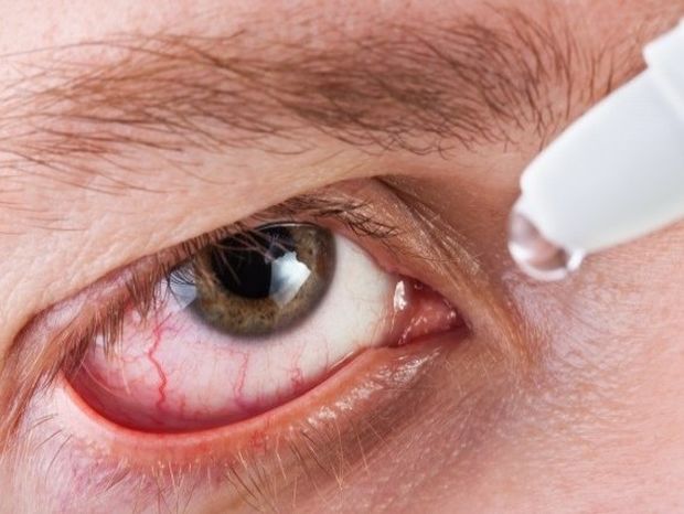 Αλλεργίες στα μάτια λόγω άνοιξης - Τρόποι αντιμετώπισης