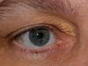 Ξανθέλασμα: Όταν η χοληστερίνη φαίνεται στα μάτια