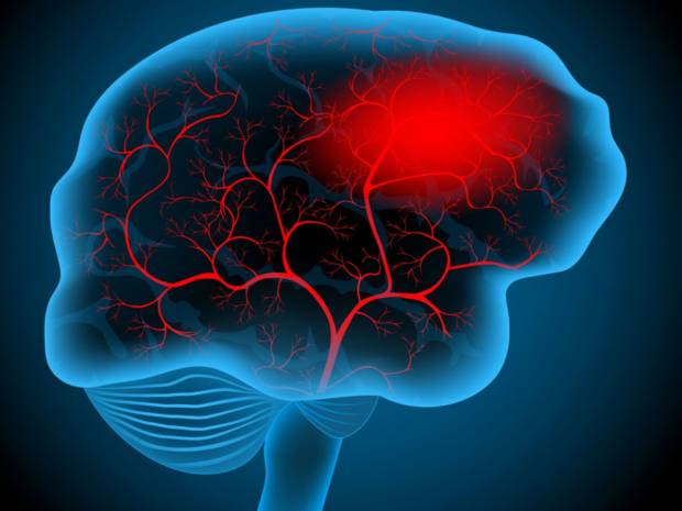 Εγκεφαλικό: Οι παράγοντες που αυξάνουν τον κίνδυνο 